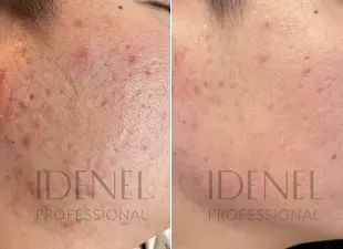 Après 6 semaines d'utilisation